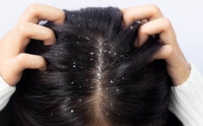 सिर में डैंड्रफ और खुजली से हैं परेशान,तो जनिए असरदार घरेलू उपाएं